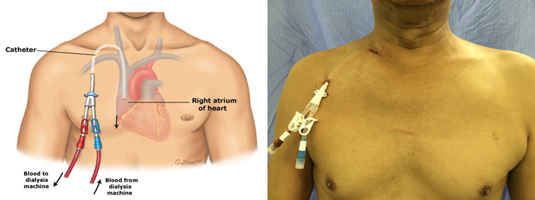 導管植入部位，一般放置於內頸靜脈處，有一段導管則是露在人體外，右邊或左邊的鎖骨下方。