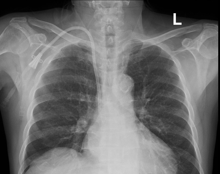 一般在術後會照胸部 X 光片確認位置