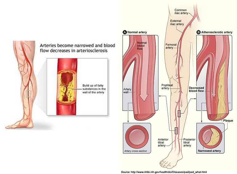 下肢動脈阻塞性疾病或周邊動脈阻塞性疾病 (Peripheral Arterial Occlusive Disease, PAOD)