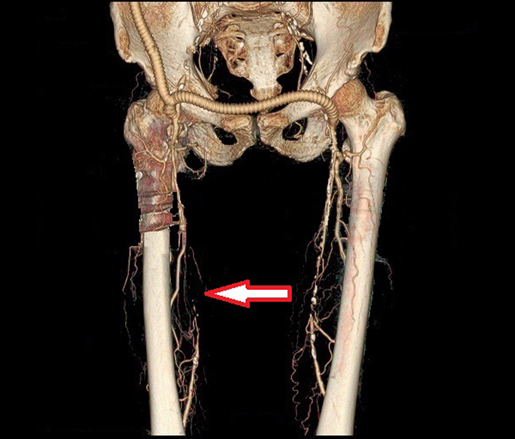 腹主動脈完全阻塞的病患，在經過鎖骨下動脈至雙側股動脈繞道手術後，我們可以看到其左側大腿的淺股動脈呈現嚴重狹窄，右側則是完全阻塞的狀況