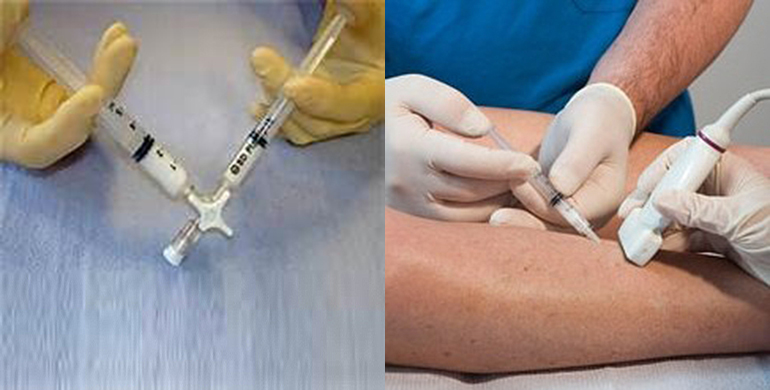 先將硬化劑打成泡沫狀，再用很細的針直接把泡沫狀的硬化劑注射到病人患肢的血管內。