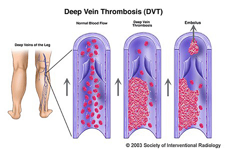 深層靜脈栓塞 (Deep vein thrombosis, DVT)