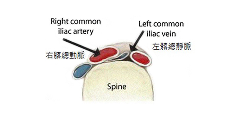 臨床最常見的是左髂總靜脈 (Left common iliac vein) 受到右髂總動脈 (Right common iliac artery) 的壓迫所致