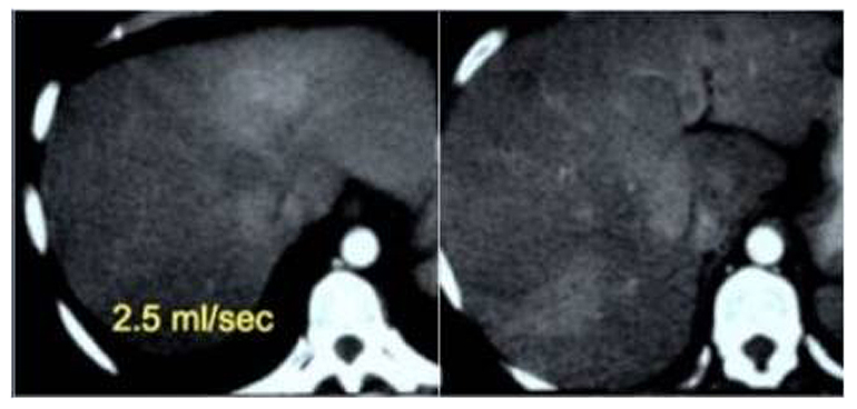 肝腫瘤以一般的人工血管做電腦斷層攝影，腫瘤的影像品質並不清楚。